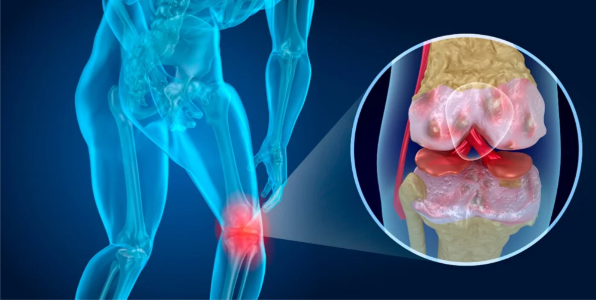 Подострый артрит