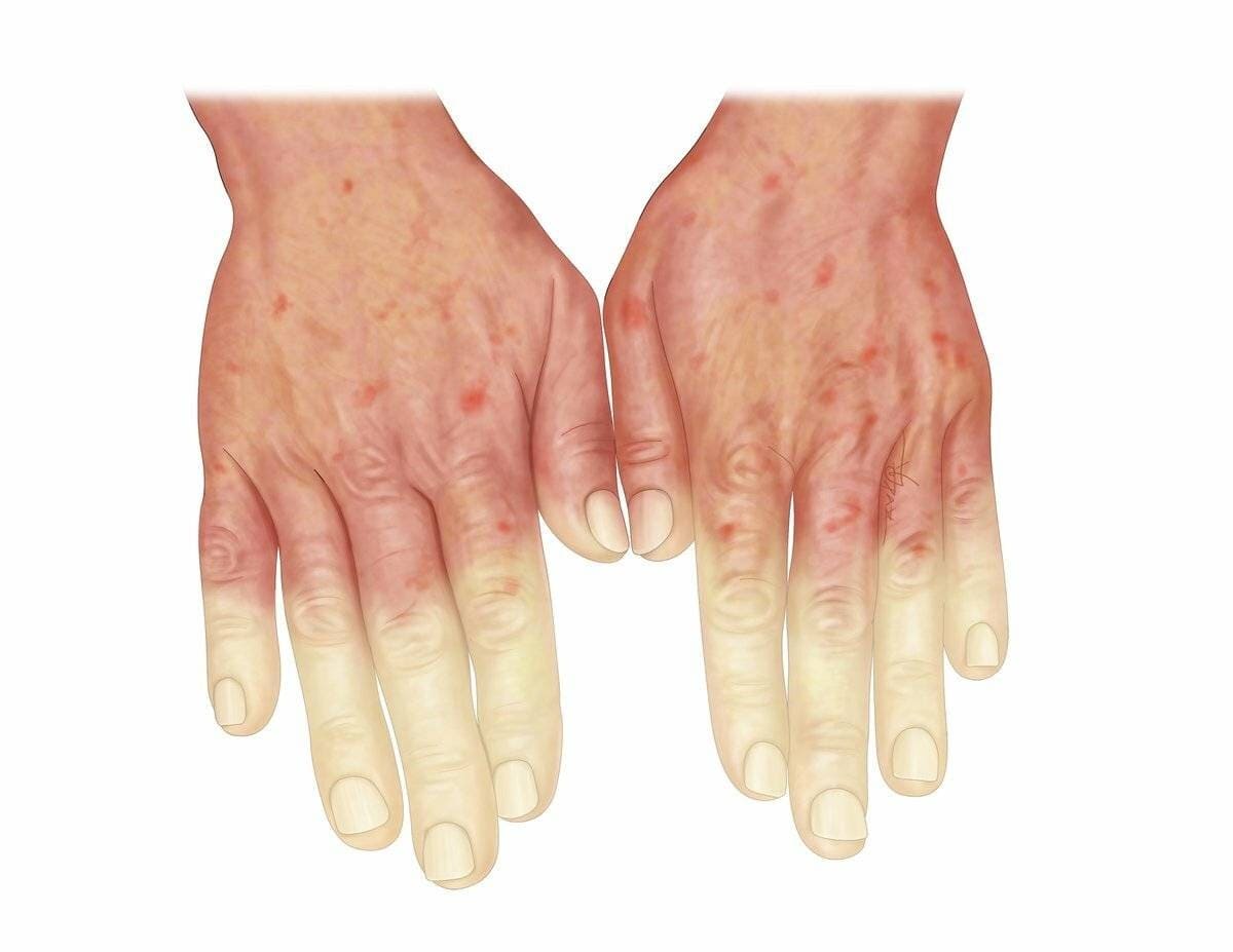 Прогноз при склеродермии: можно ли жить полноценно?